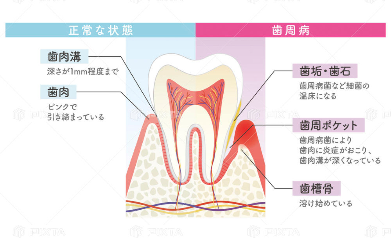 歯周病説明図